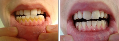 dentalna-hygiena